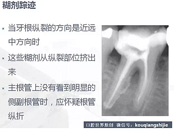 牙根纵裂