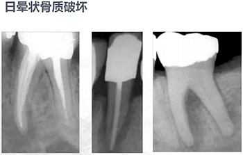 牙根纵裂