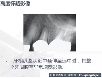 牙根纵裂