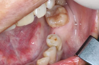 【病例分享】Implant Guide?数字化全程导航及椅旁即刻修复一例