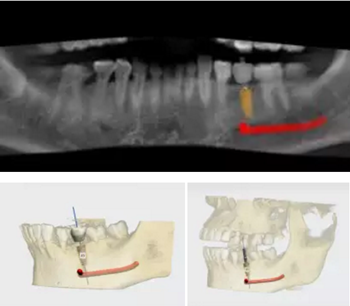 【病例分享】Implant Guide?数字化全程导航及椅旁即刻修复一例