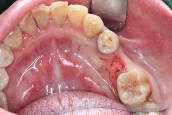 【病例分享】Implant Guide?数字化全程导航及椅旁即刻修复一例