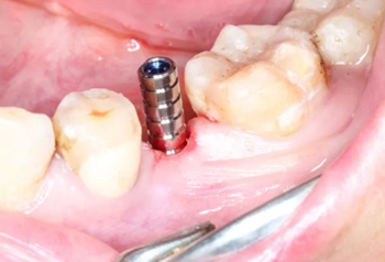 【病例分享】Implant Guide?数字化全程导航及椅旁即刻修复一例