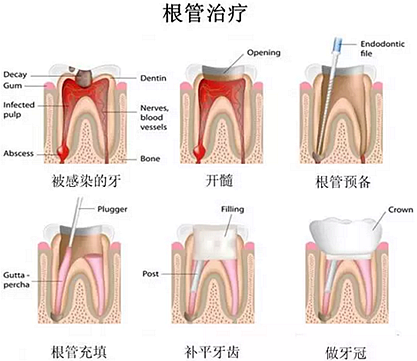 【科普】牙齿根管治疗大全