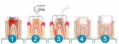【科普】牙齿根管治疗大全