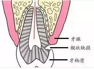 楔状缺损是几个意思 ?