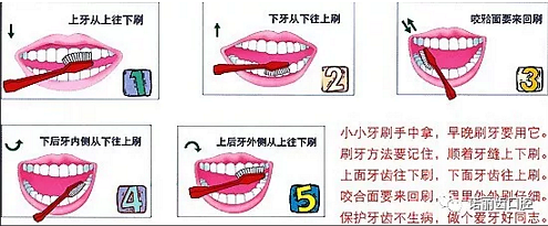 楔状缺损是几个意思 ?