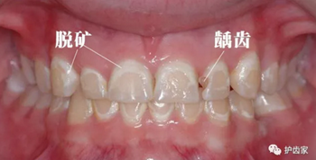 脱矿与龋齿的关系