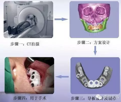 牙技术丨牙科种植导板在临床中的应用