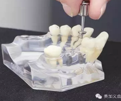 牙技术丨牙科种植导板在临床中的应用