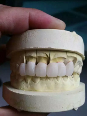 什么牙齿最适合做烤瓷牙