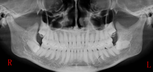 [颌面外科] 赵吉宏教授教你分析阻生牙阻力及画分冠线