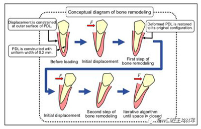 正畸文献阅读--对于滑动法关闭间隙的有限元分析
