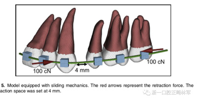 正畸文献阅读--对于滑动法关闭间隙的有限元分析