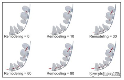 正畸文献阅读--对于滑动法关闭间隙的有限元分析