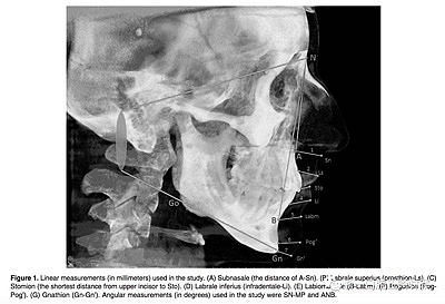 正畸文献阅读--使用CBCT评估具有不同垂直生长模式的成人患者的面下1/3的软组织厚度值