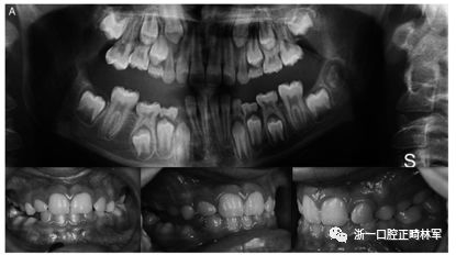 正畸文献阅读--原发性萌出失败：混合牙列的临床和遗传学研究