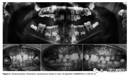 正畸文献阅读--原发性萌出失败：混合牙列的临床和遗传学研究