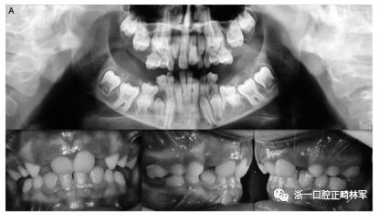 正畸文献阅读--原发性萌出失败：混合牙列的临床和遗传学研究