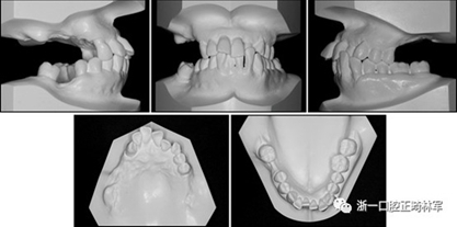 文献优秀正畸病例赏析--多颗牙齿缺失的牙周炎患者的跨学科综合治疗