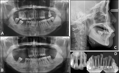 文献优秀正畸病例赏析--多颗牙齿缺失的牙周炎患者的跨学科综合治疗