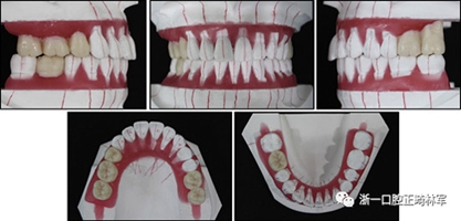 文献优秀正畸病例赏析--多颗牙齿缺失的牙周炎患者的跨学科综合治疗