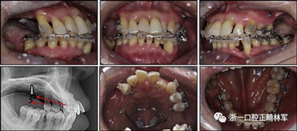 文献优秀正畸病例赏析--多颗牙齿缺失的牙周炎患者的跨学科综合治疗