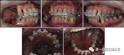 文献优秀正畸病例赏析--多颗牙齿缺失的牙周炎患者的跨学科综合治疗