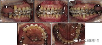 文献优秀正畸病例赏析--多颗牙齿缺失的牙周炎患者的跨学科综合治疗