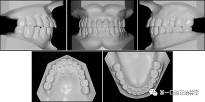 文献优秀正畸病例赏析--多颗牙齿缺失的牙周炎患者的跨学科综合治疗