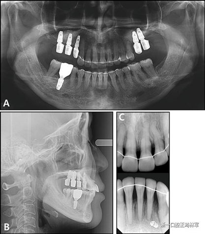 文献优秀正畸病例赏析--多颗牙齿缺失的牙周炎患者的跨学科综合治疗