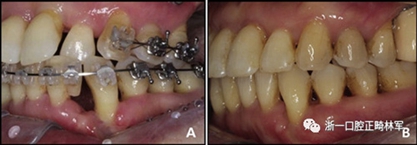 文献优秀正畸病例赏析--多颗牙齿缺失的牙周炎患者的跨学科综合治疗