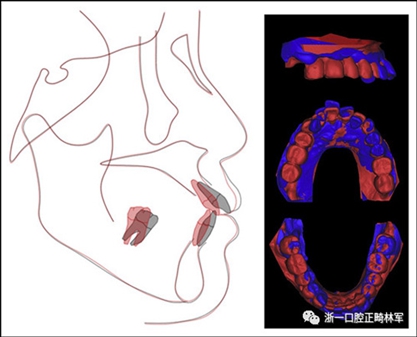 文献优秀正畸病例赏析--多颗牙齿缺失的牙周炎患者的跨学科综合治疗