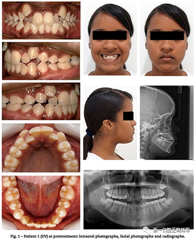 文献优秀正畸病例赏析--同卵双胞胎使用自锁托槽和传统托槽正畸治疗比较