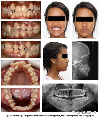 文献优秀正畸病例赏析--同卵双胞胎使用自锁托槽和传统托槽正畸治疗比较