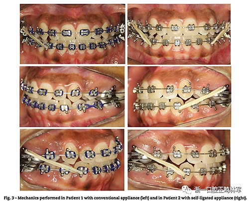 文献优秀正畸病例赏析--同卵双胞胎使用自锁托槽和传统托槽正畸治疗比较