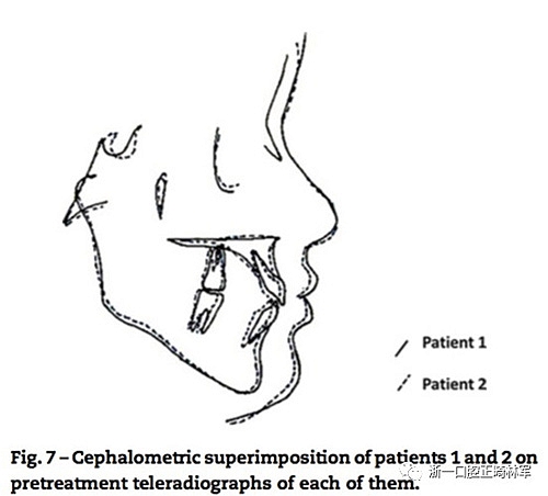 文献优秀正畸病例赏析--同卵双胞胎使用自锁托槽和传统托槽正畸治疗比较