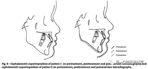 文献优秀正畸病例赏析--同卵双胞胎使用自锁托槽和传统托槽正畸治疗比较