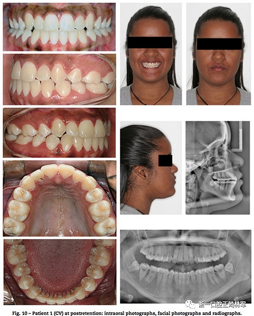 文献优秀正畸病例赏析--同卵双胞胎使用自锁托槽和传统托槽正畸治疗比较