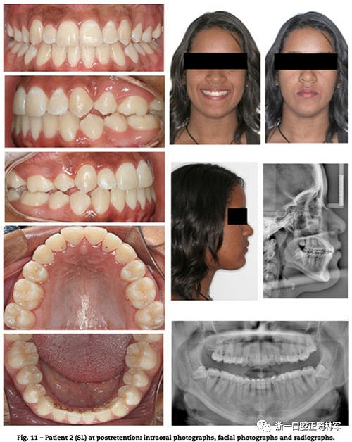 文献优秀正畸病例赏析--同卵双胞胎使用自锁托槽和传统托槽正畸治疗比较