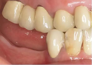 多学科联合种植修复治疗罹患广泛性重度慢性牙周炎病例（I）