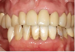 多学科联合种植修复治疗罹患广泛性重度慢性牙周炎病例（I）