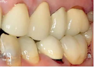 多学科联合种植修复治疗罹患广泛性重度慢性牙周炎病例（I）