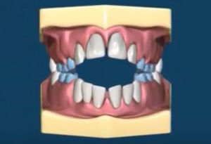 	12岁前必须处理的20种儿童牙颌畸形【口腔科普】