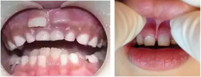 	12岁前必须处理的20种儿童牙颌畸形【口腔科普】