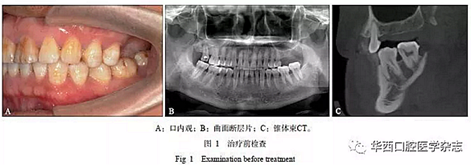 利用压膜式活动矫治器压入下颌第一、第二磨牙1例