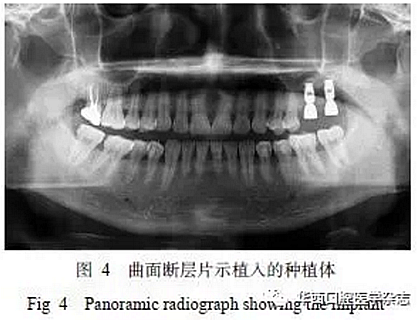 利用压膜式活动矫治器压入下颌第一、第二磨牙1例