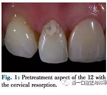 文献优秀正畸病例赏析--正畸牙周联合治疗方法病例介绍