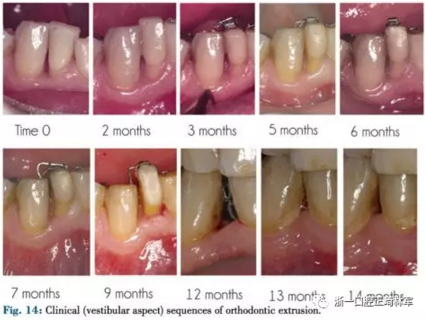 文献优秀正畸病例赏析--正畸牙周联合治疗方法病例介绍
