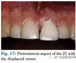 文献优秀正畸病例赏析--正畸牙周联合治疗方法病例介绍